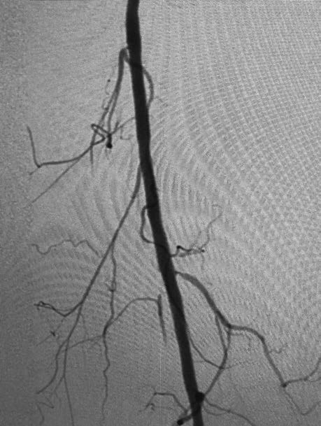 After-Angio-and-Stent-Placement-in-SFA