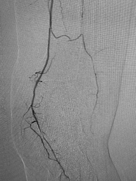 Post-Intervention: Distal Posterior Tibial
