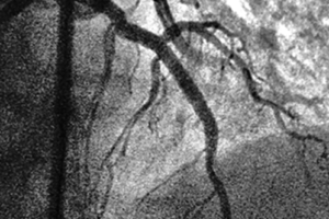 A Coronary Artery that is severely calcified