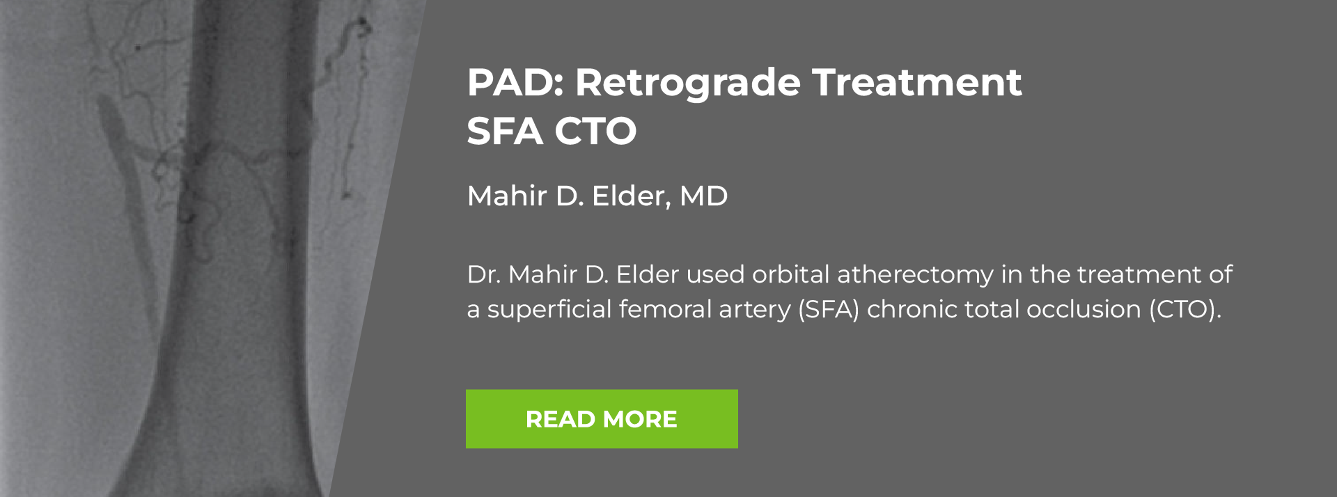 P A D Case Study: Retrograde treatment S F A C T O