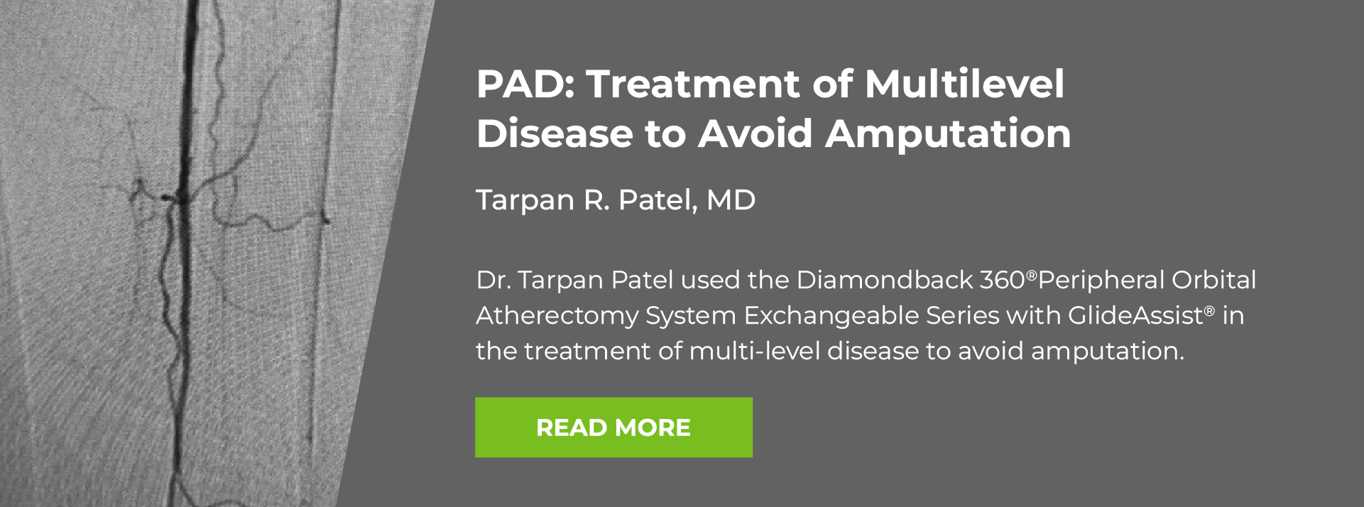 Case study: Peripheral Artery Disease:Treatment of Multilevel Disease to Avoid Amputation