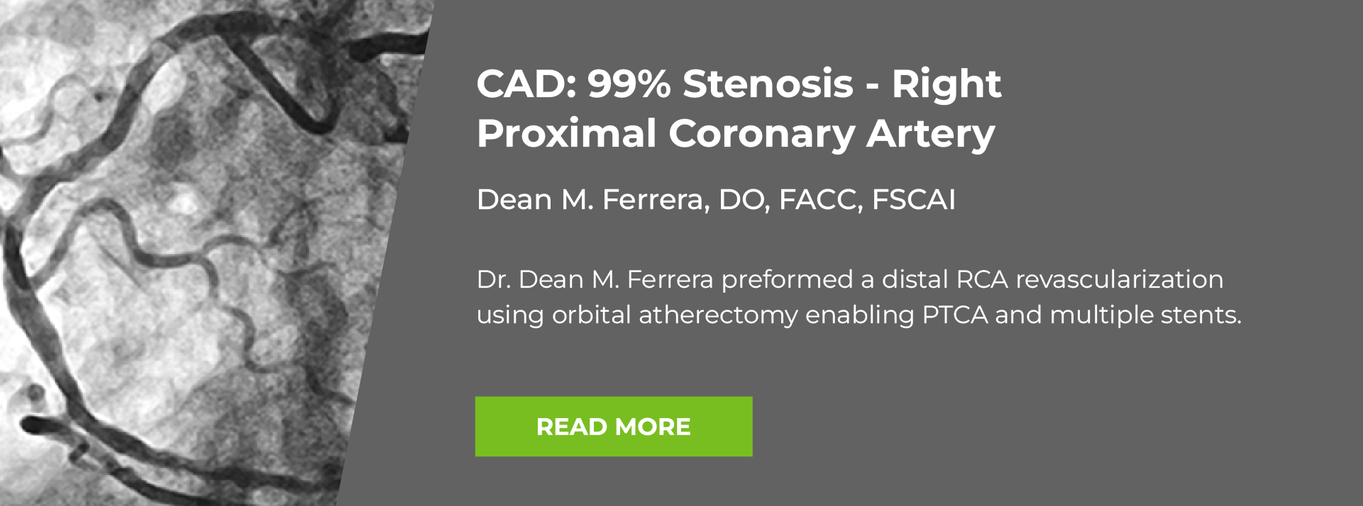 Corronay Artery disease Case Study slide 4 about stenonsis in the right proximal coronary artery
