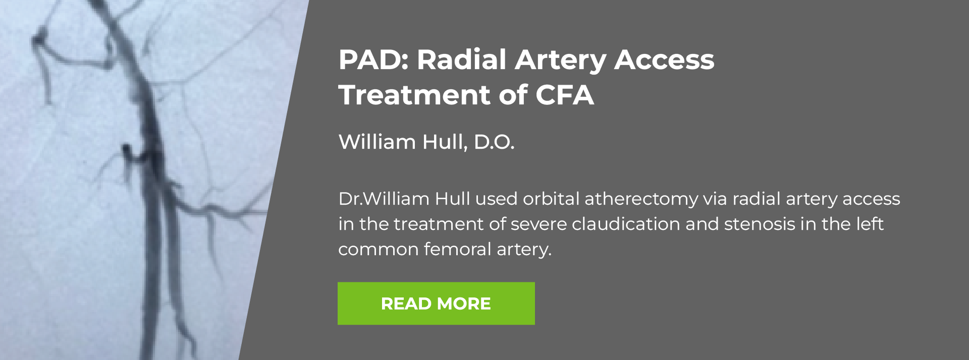 One Solution Case Study. P A D: Radial Artery Access Treament of C F A