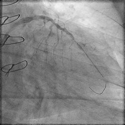 Figure 5_Angiography of LAD Showing 2.25 x 38 mm Stent Deployment