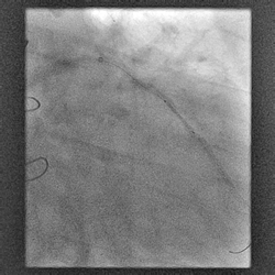 Figure-6_Angiography-of-LAD-Showing-2.75-x-15-mm-Stent-Deployment