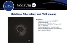 Scoreflex Slide showing Diamondback Orbital Artherectomy system procedure