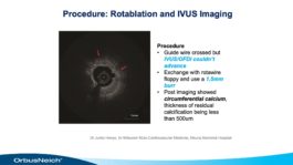 Scoreflex Slide showing Diamondback Orbital Artherectomy system procedure