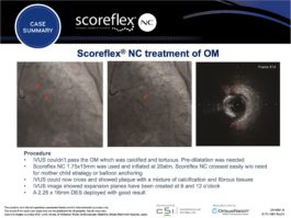 A slide of a case summary regarding the Scoreflex NC treatment of O M