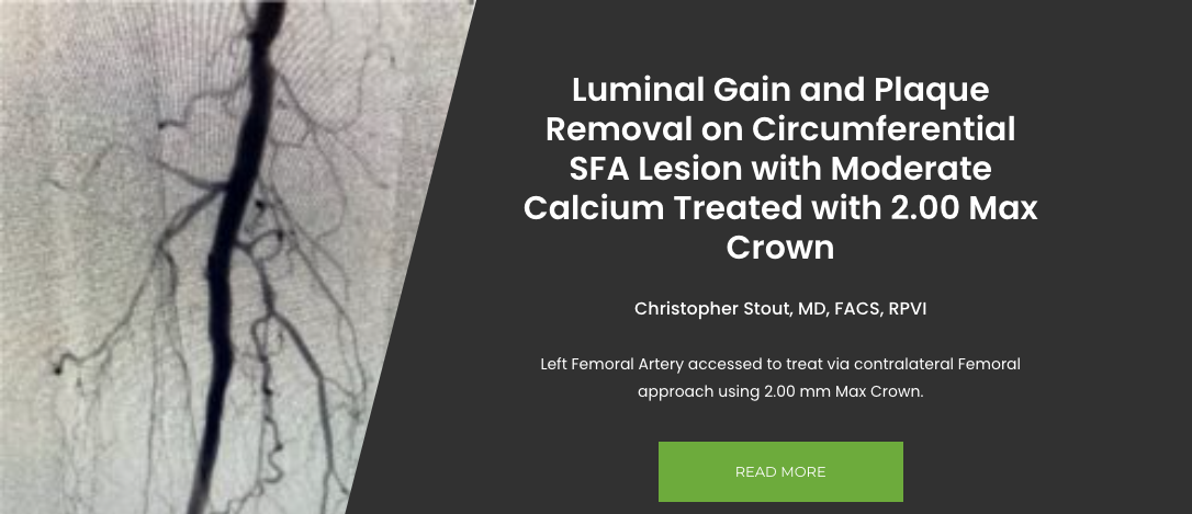 Luminal Gain and Plaque Removal on Circumferential Femoropopliteal Lesion with Moderate Calcium Treated with 2.00 Max Crown