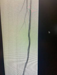 Mixed plaque lesion treated with 2.00 Max Crown orbital atherectomy for peripheral artery disease